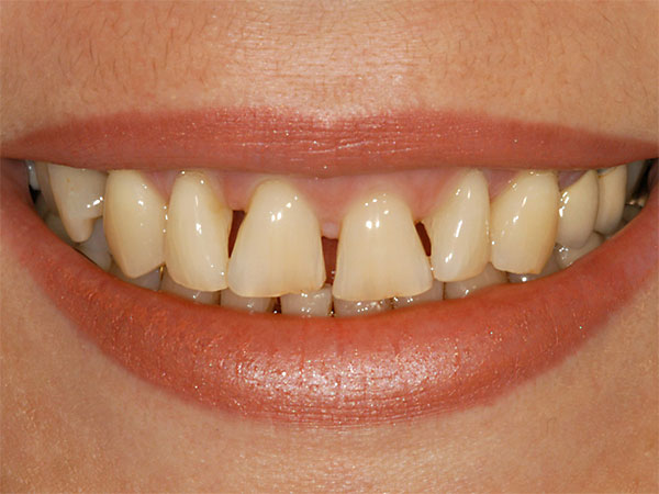 Zahnverbreiterung Composite