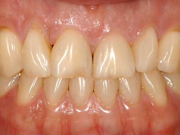 Zahnverbreiterung Composite