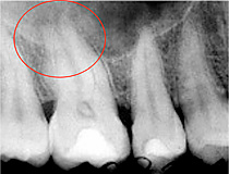 files/Dateien/Bilder/Leistungen/Endodontie/endo_ok_sz_01.jpg