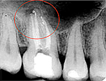 files/Dateien/Bilder/Leistungen/Endodontie/endo_ok_sz_02.jpg