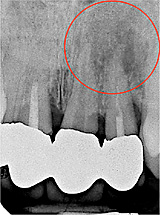 files/Dateien/Bilder/Leistungen/Endodontie/endo_ok_sz_04.jpg