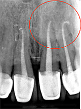 files/Dateien/Bilder/Leistungen/Endodontie/endo_ok_sz_05.jpg