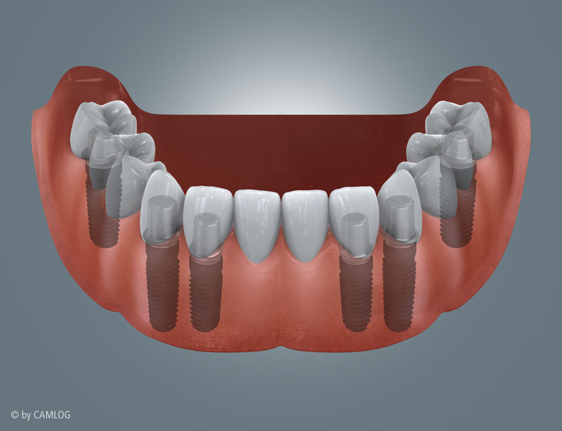 Implantatprothetik Zahnarzt Dr. Rupp Muellheim Badenweiler