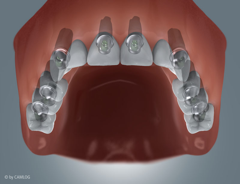 Implantatprothetik Zahnarzt Dr. Rupp Muellheim Badenweiler