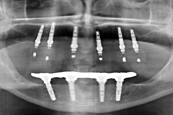 Implantatprothetik Zahnarzt Dr. Rupp Muellheim Badenweiler