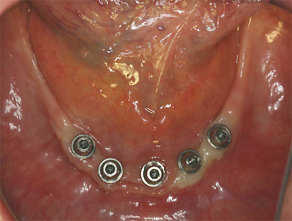 Implantatprothetik Zahnarzt Dr. Rupp Muellheim Badenweiler