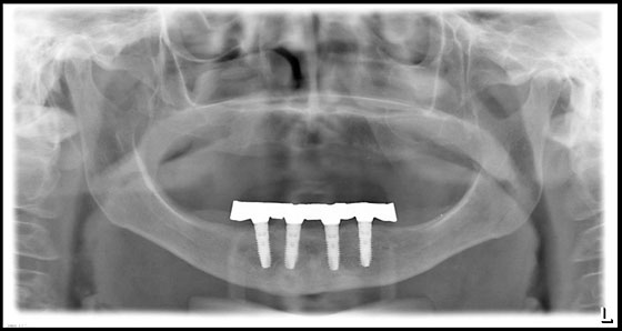 Implantatprothetik Zahnarzt Dr. Rupp Muellheim Badenweiler