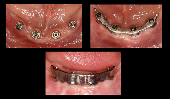 Implantatprothetik Zahnarzt Dr. Rupp Muellheim Badenweiler